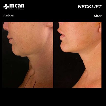 neck lift turkey before after 01