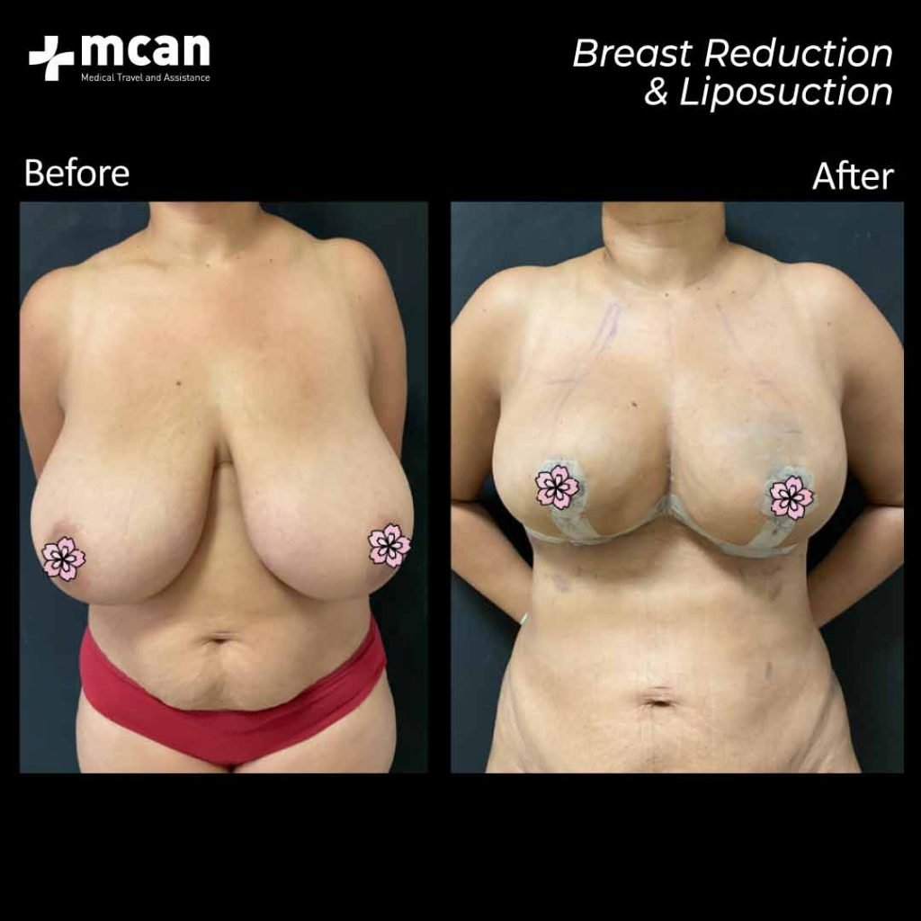07.08.20 breast reduction liposuction