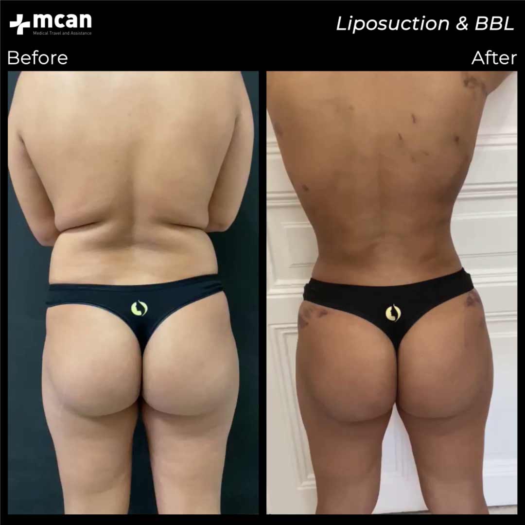 07.08.20 liposuction bbl