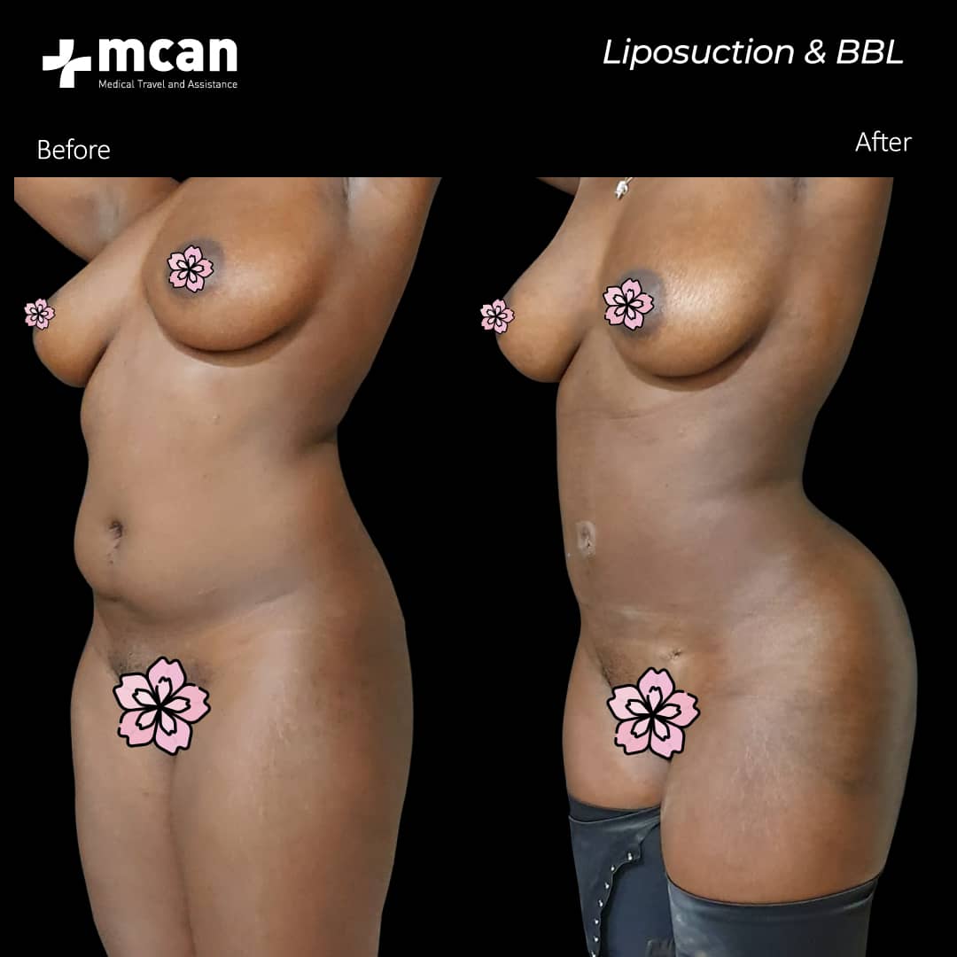 09.03.2020 liposuction bbl