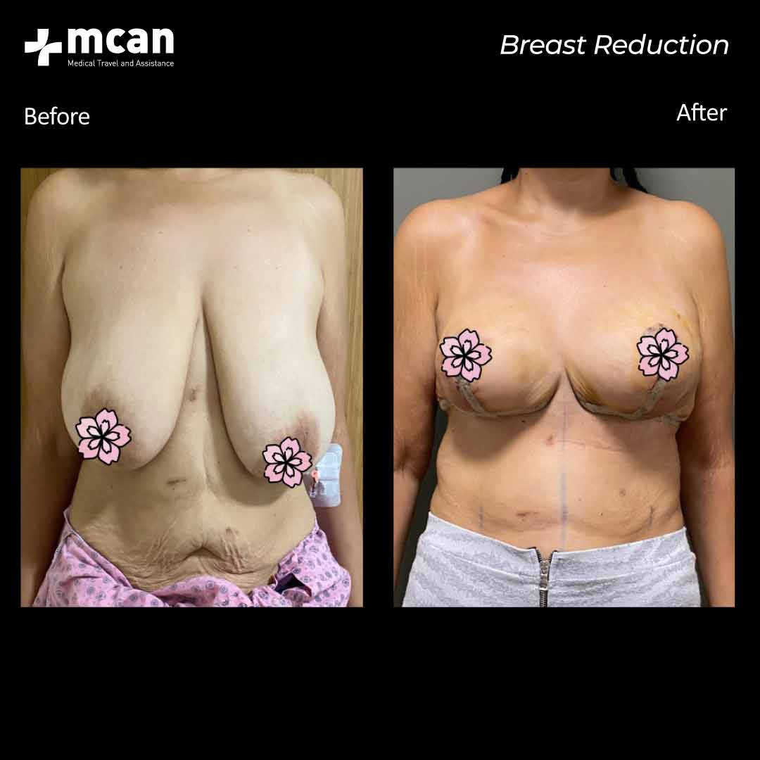 09.09.20 breast reduction