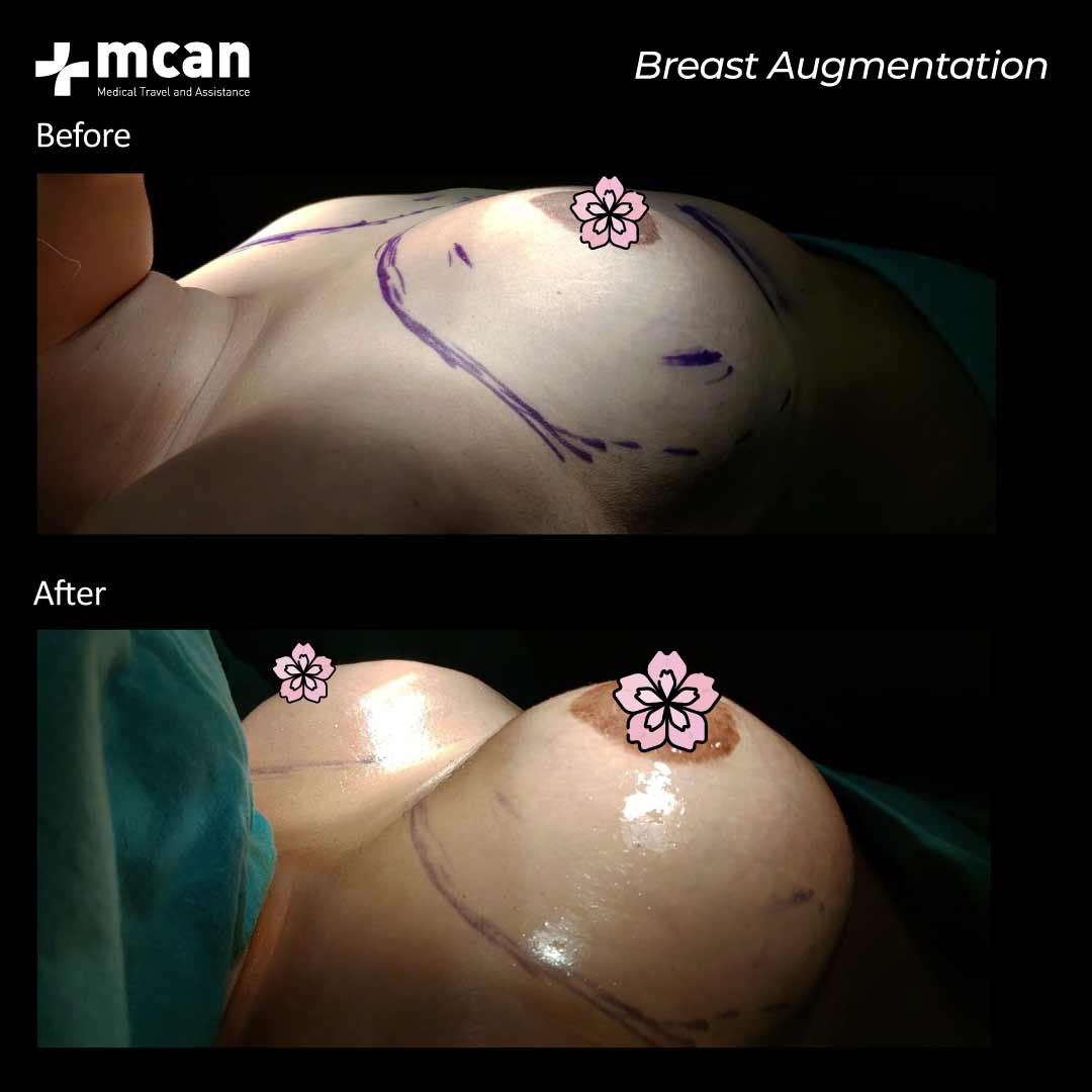 10.07.20 breast augmentation