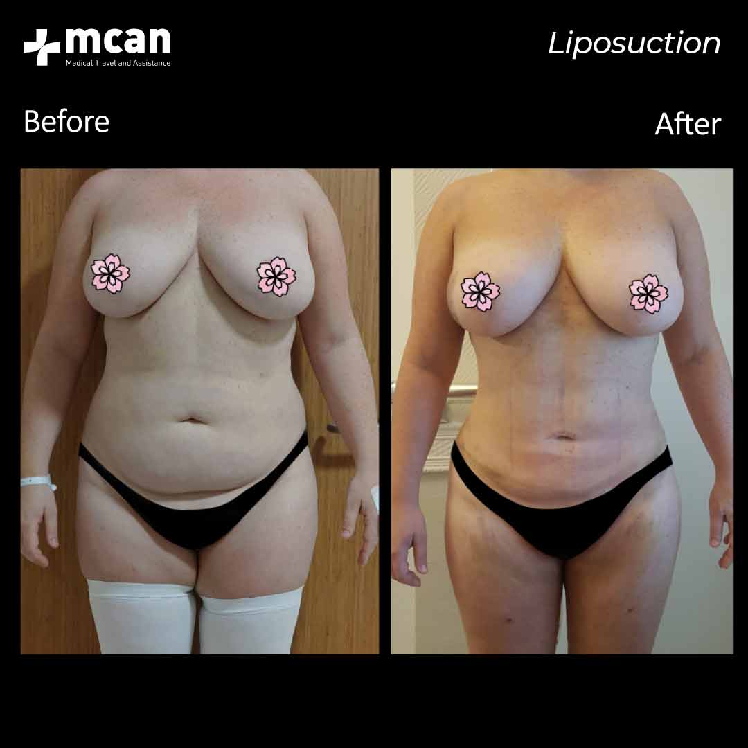 10.07.20 liposuction