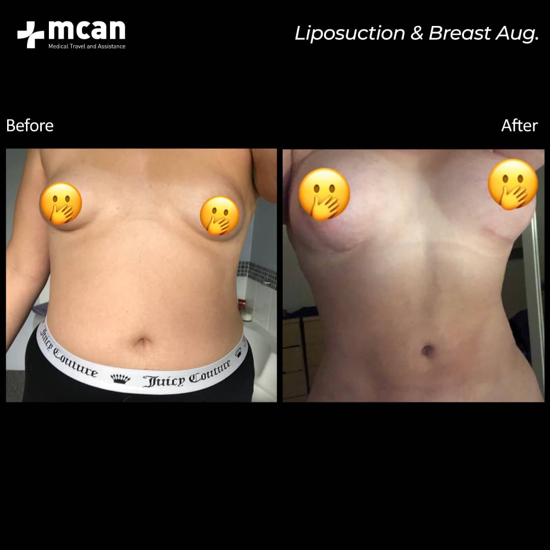 11.05.20 liposuction and breast 1