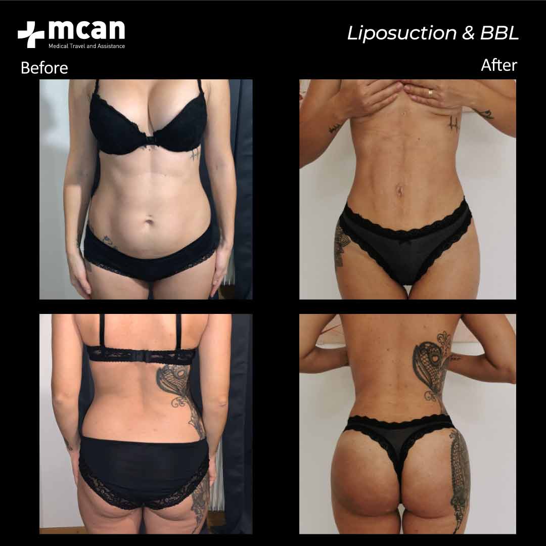 11.08.20 liposuction bbl