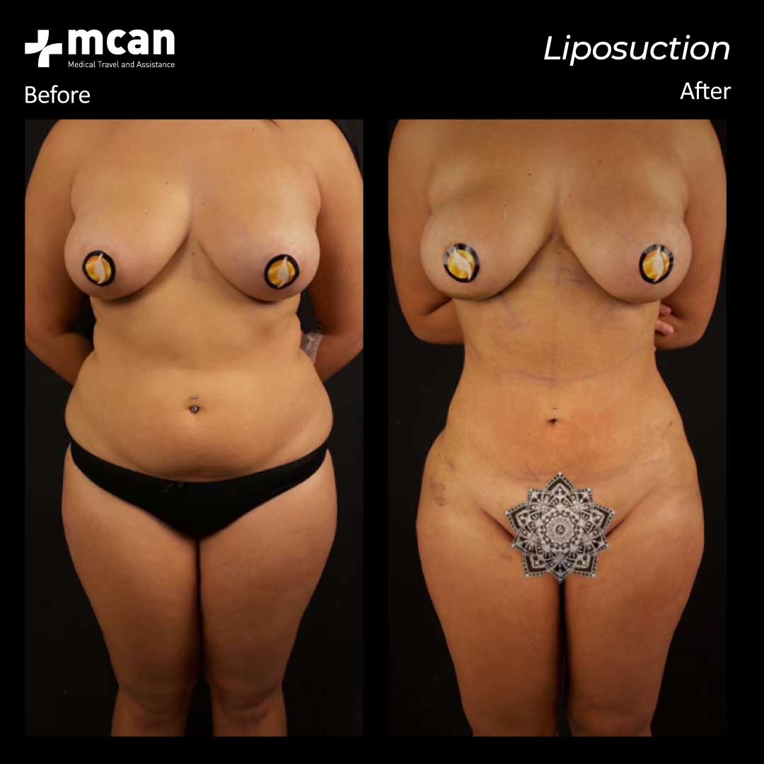 15.10.20 liposuction