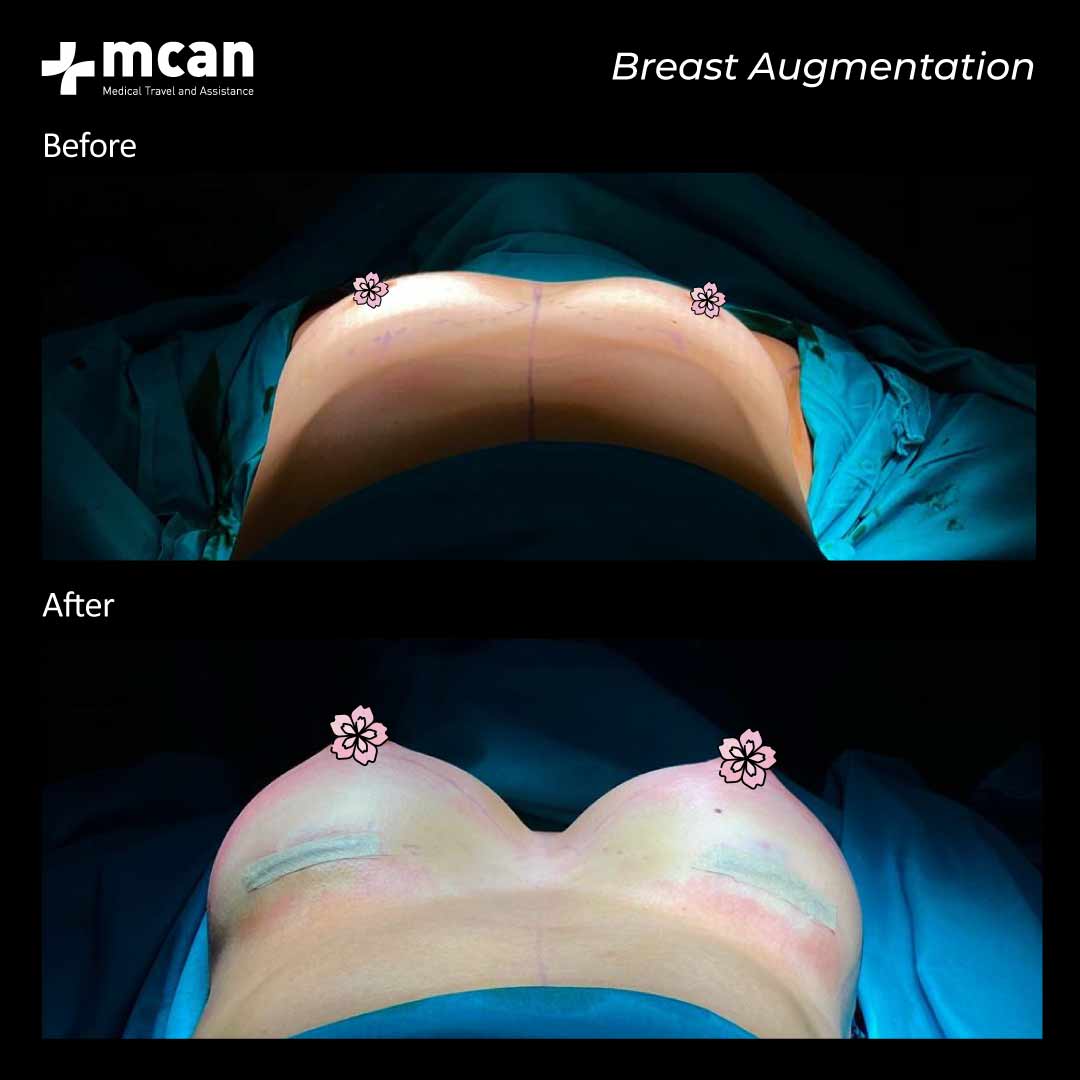 15.12.2020 breast augmentation before after