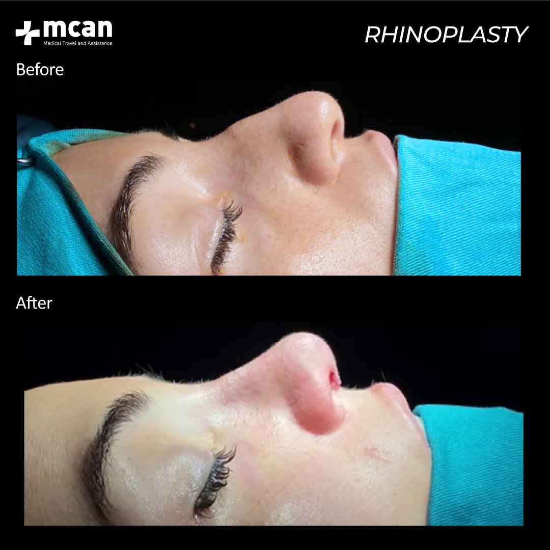 15.12.2020 rhinoplasty before after