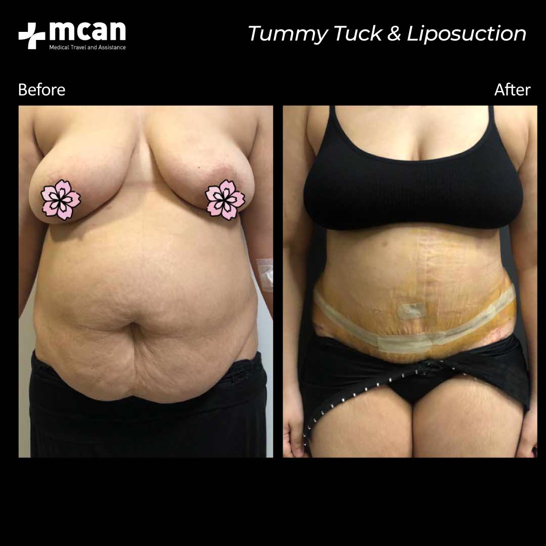 15.12.2020 tummy tuck liposuction before after 2