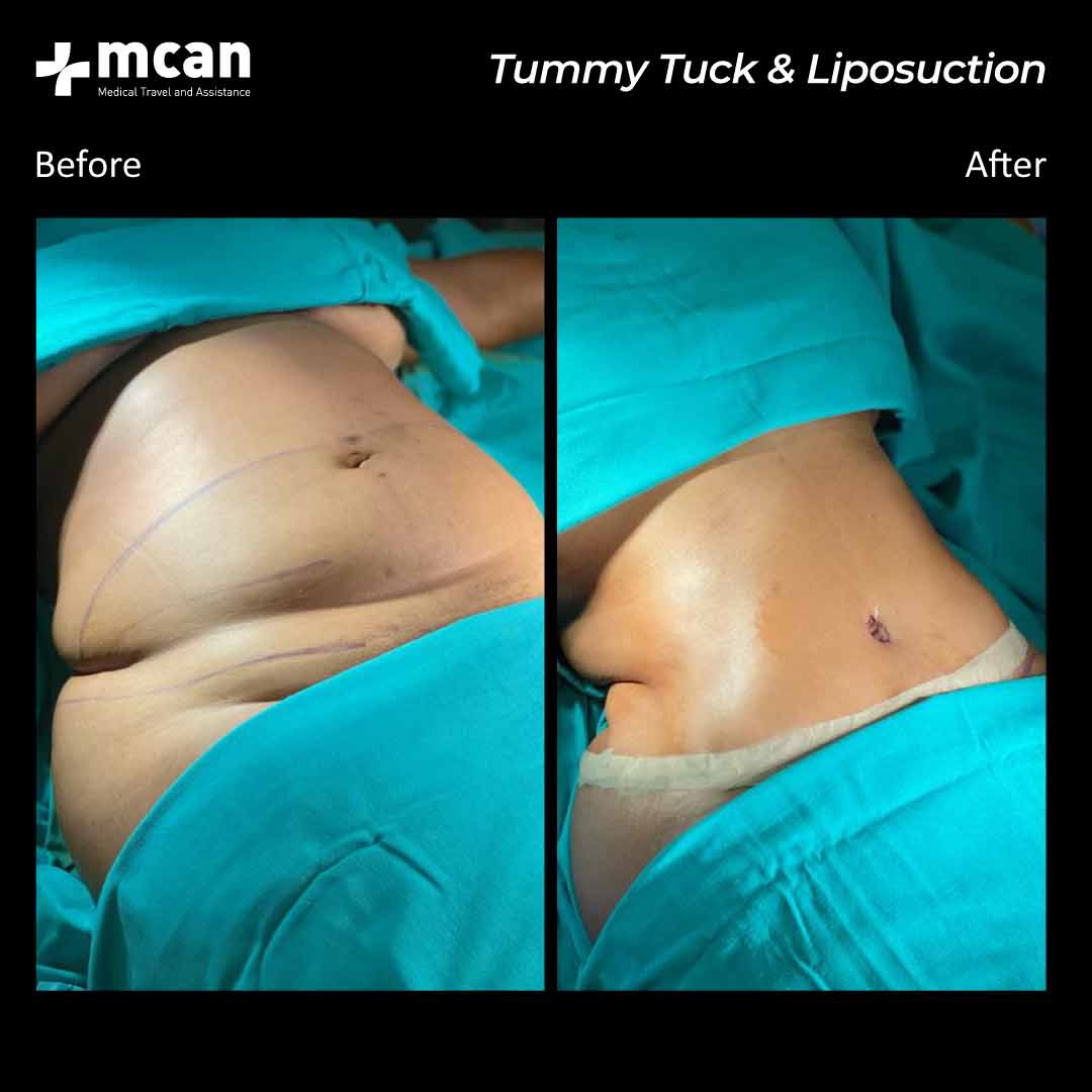 15.12.2020 tummy tuck liposuction before after 4