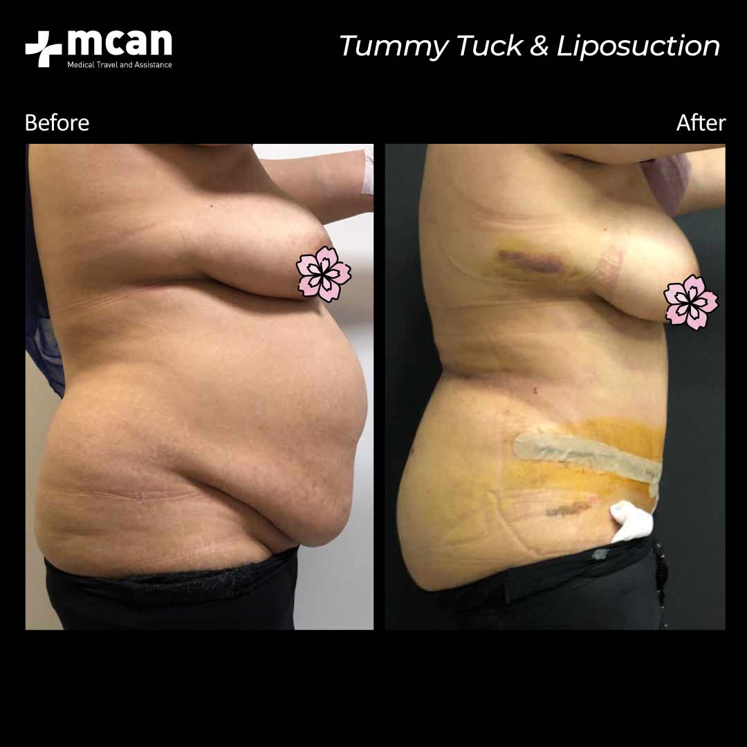 15.12.2020 tummy tuck liposuction before after