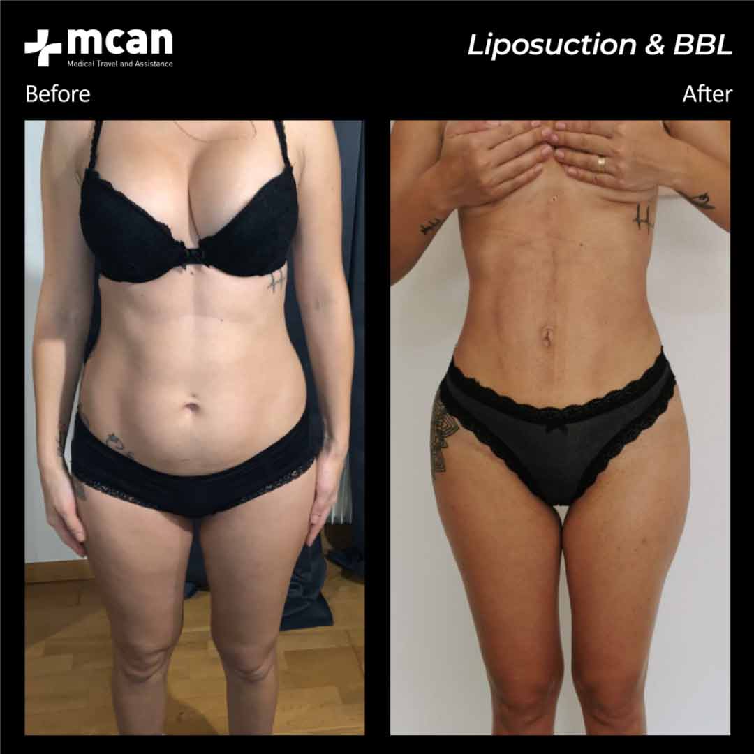 17.08.20 liposuction bbl