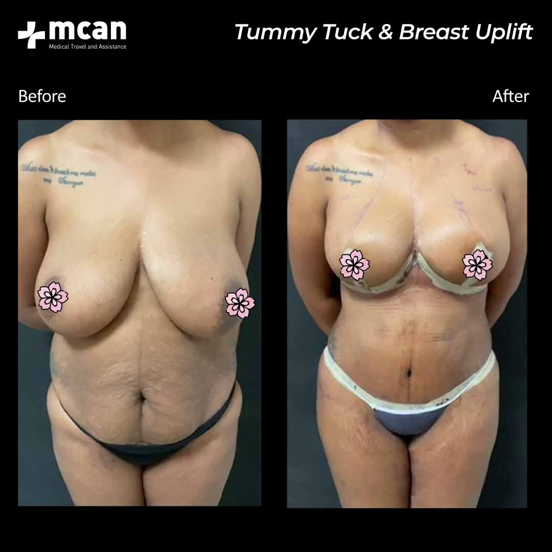 17.08.20 tummy tuck breast uplift 1
