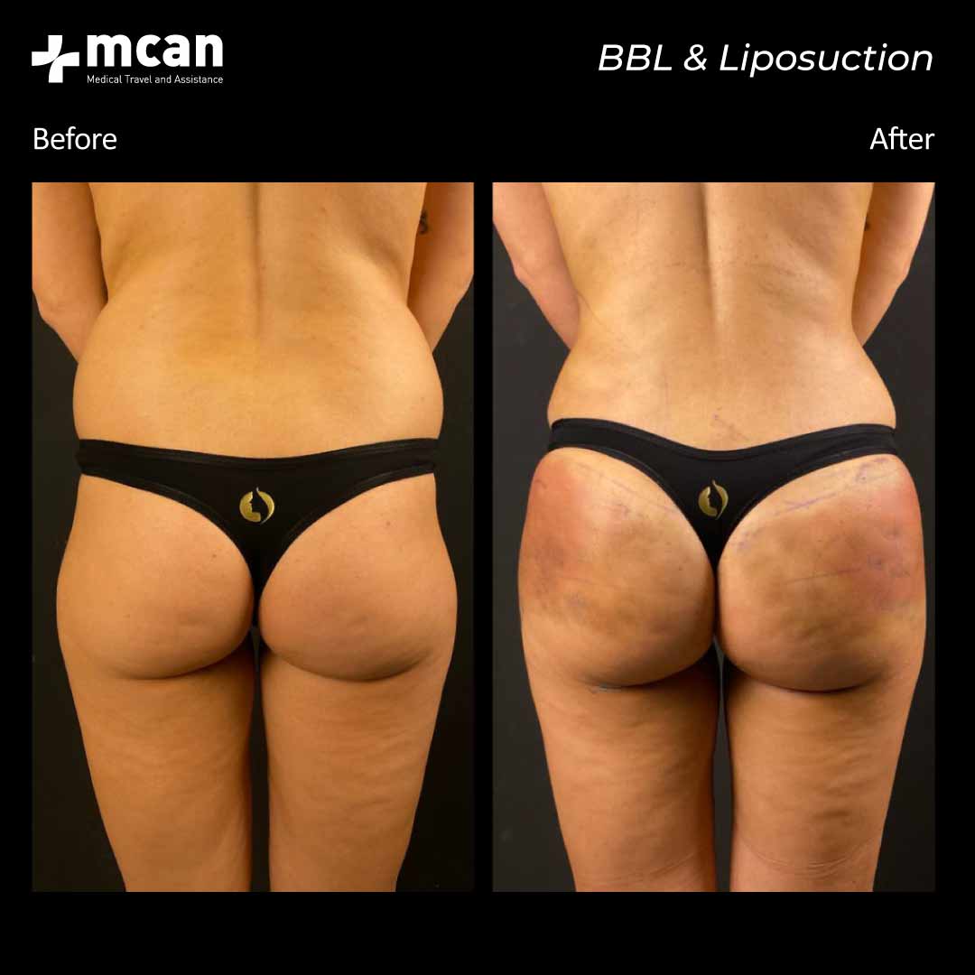 19.11.20 bbl liposuction 2