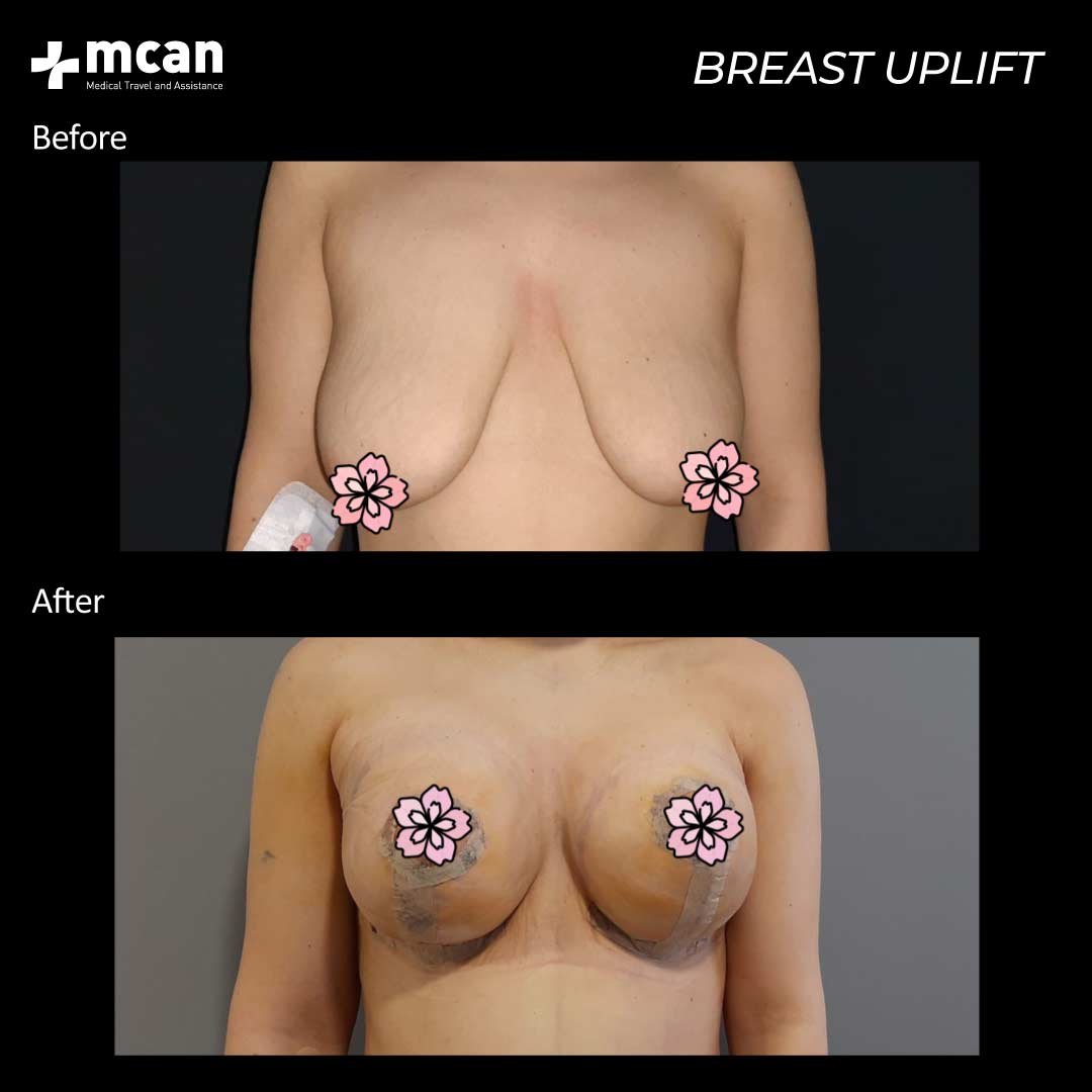 19.11.20 breast uplift 3