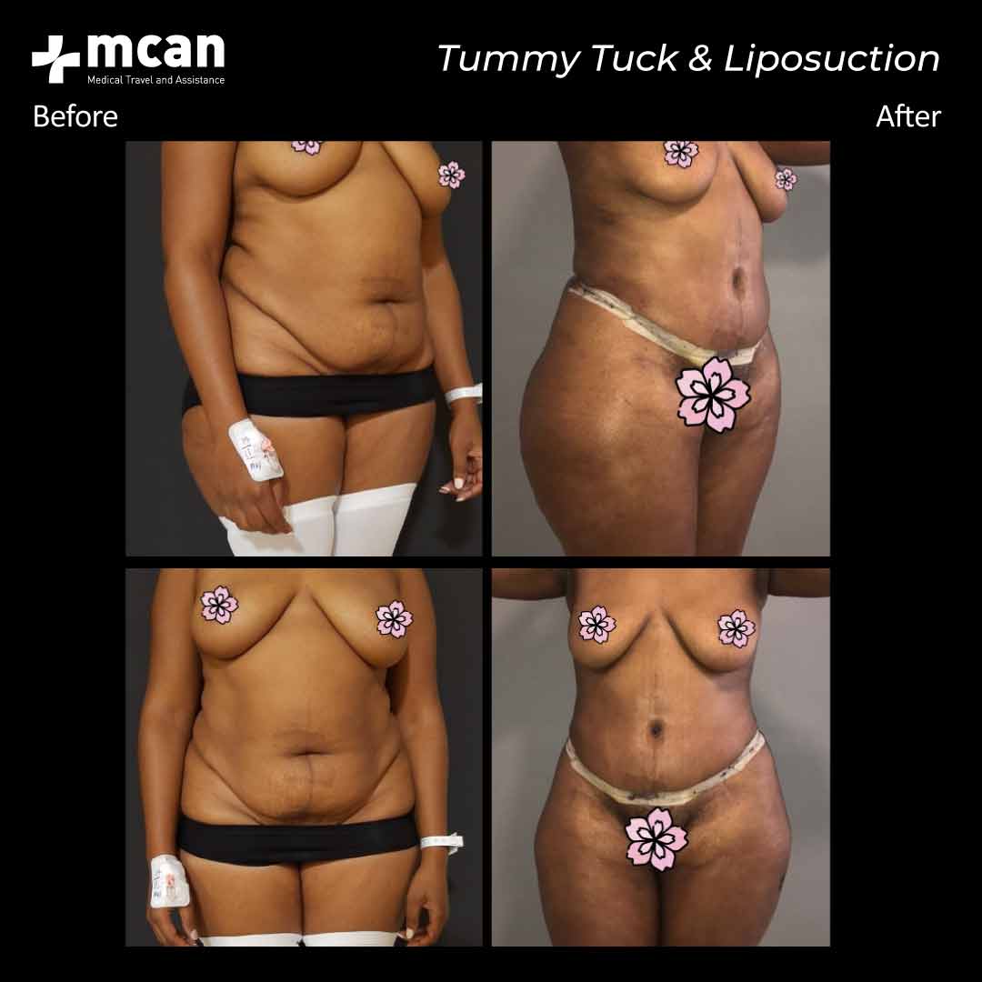 19.11.20 tummy tuck liposuction
