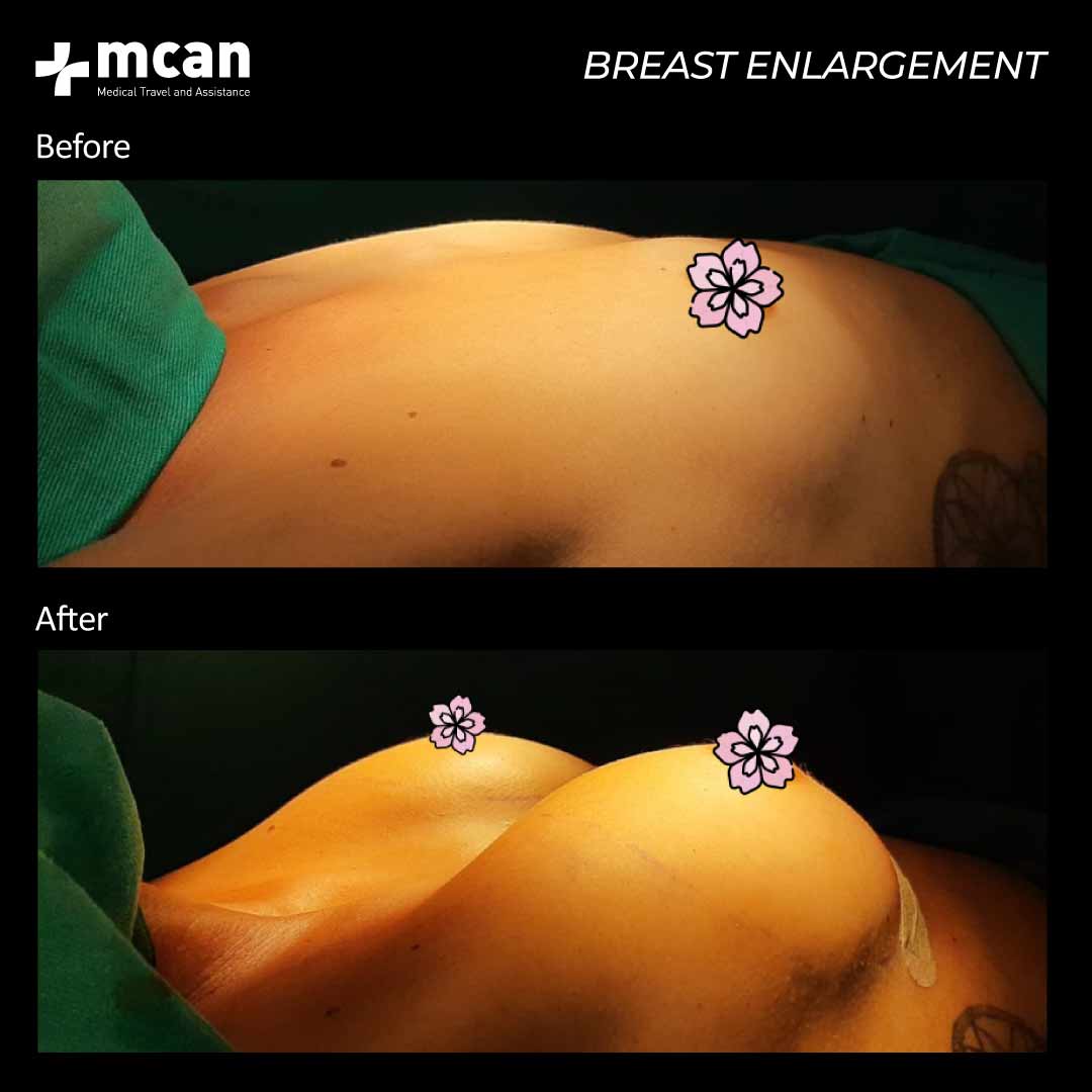 21.07.20 breast enlargement