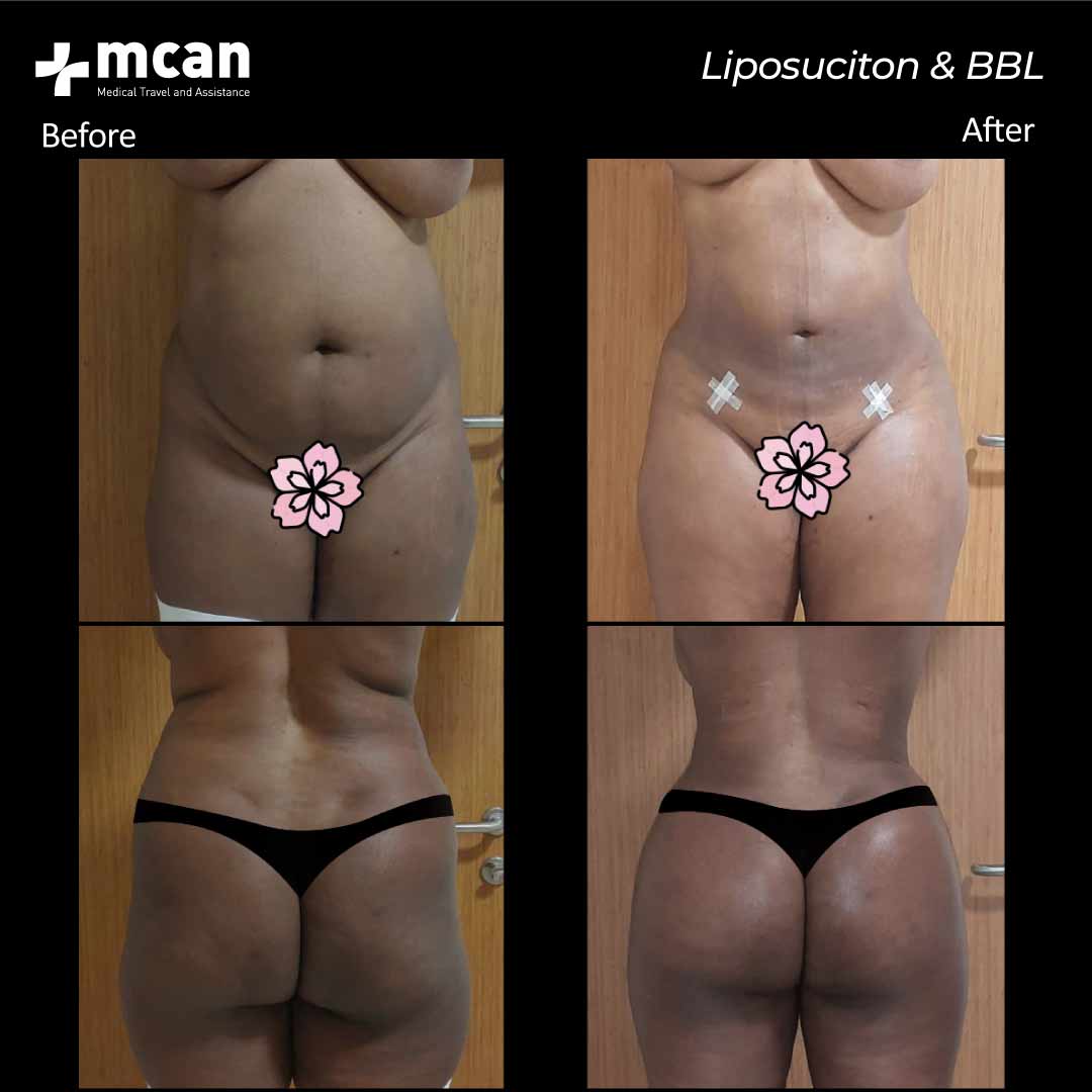 21.07.20 liposuction bbl 2