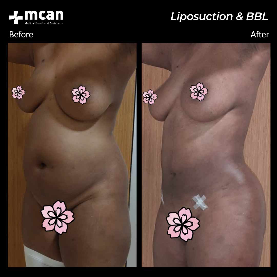 21.07.20 liposuction bbl