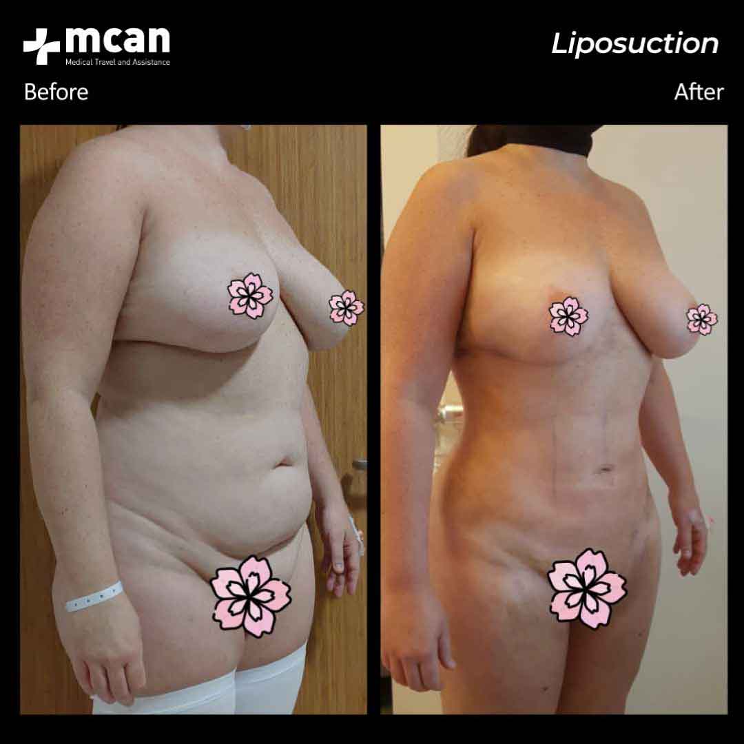 21.07.20 liposuction