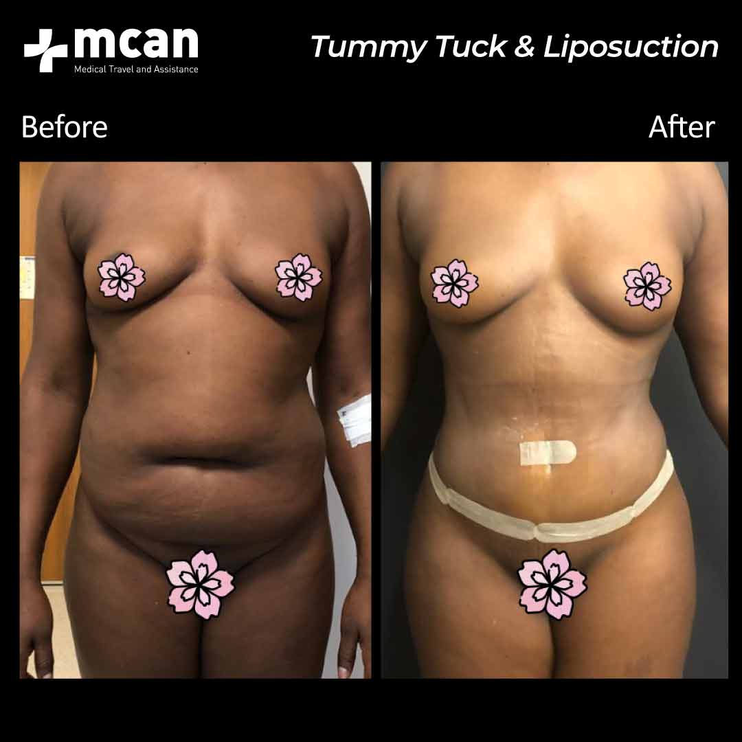 21.09.20 tummy tuck liposuction