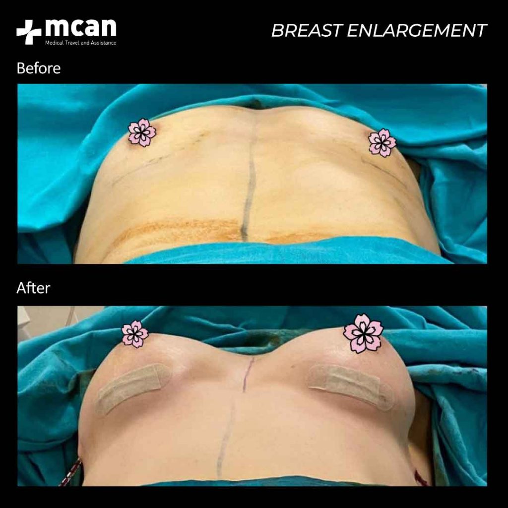 23.07.20 breast enlargement 1024x1024 1