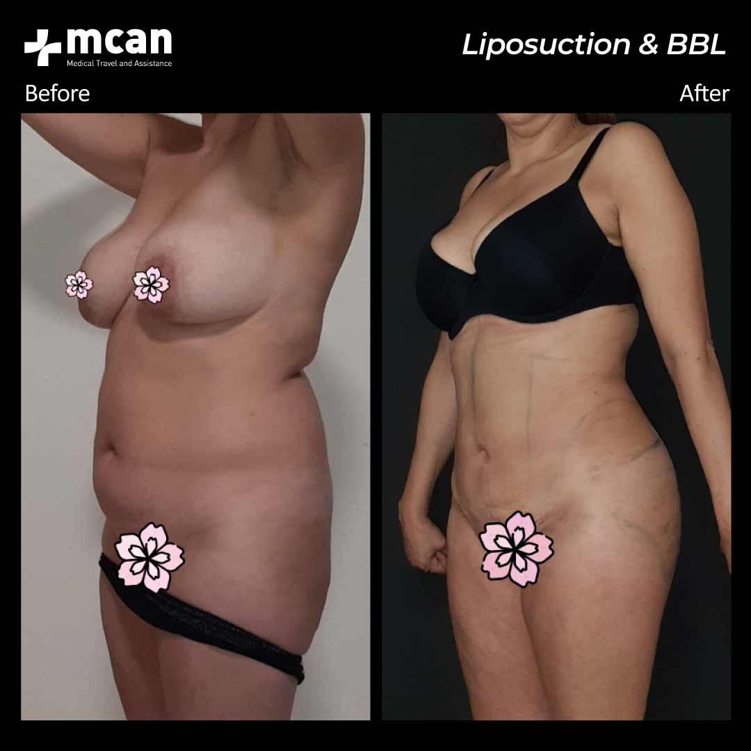 23.07.20 liposuction bbl 2
