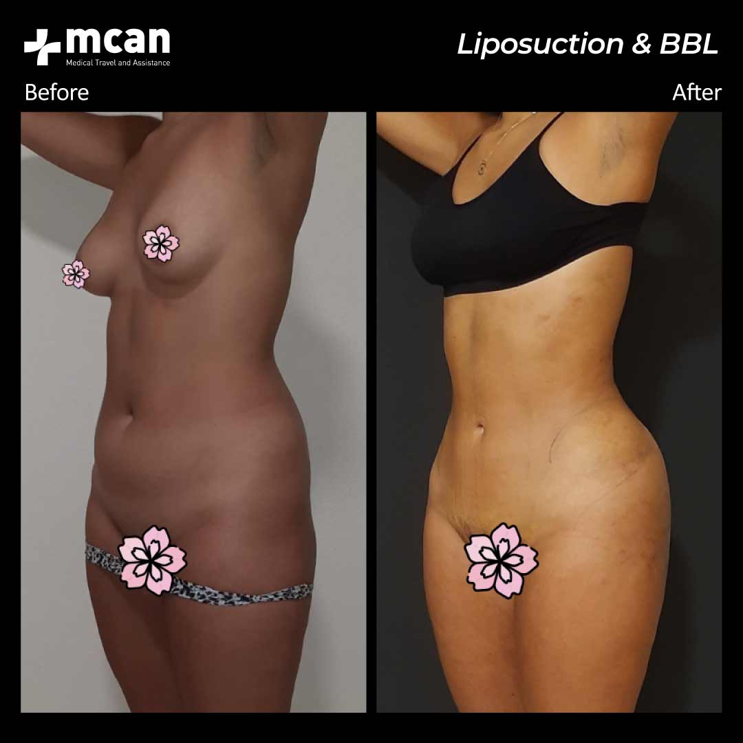 23.07.20 liposuction bbl