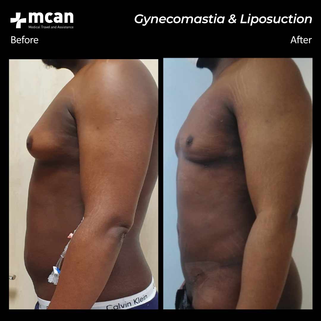 26.06.20 gynecomastia liposuction