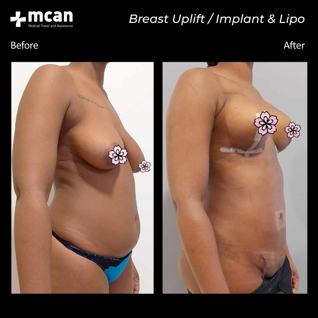 27.11.20 breast uplift 1