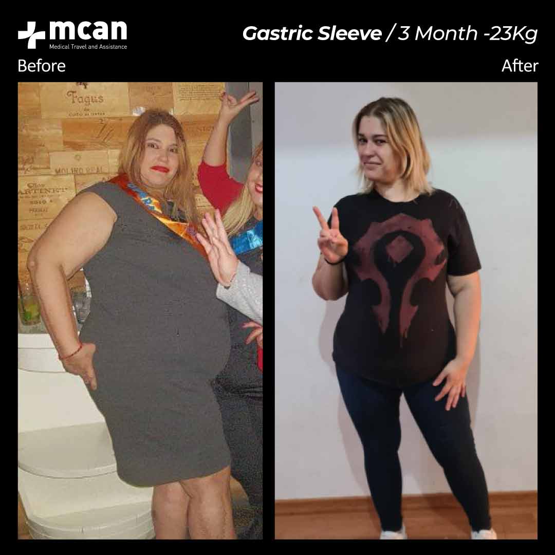 3.12.20 gastric sleeve before after