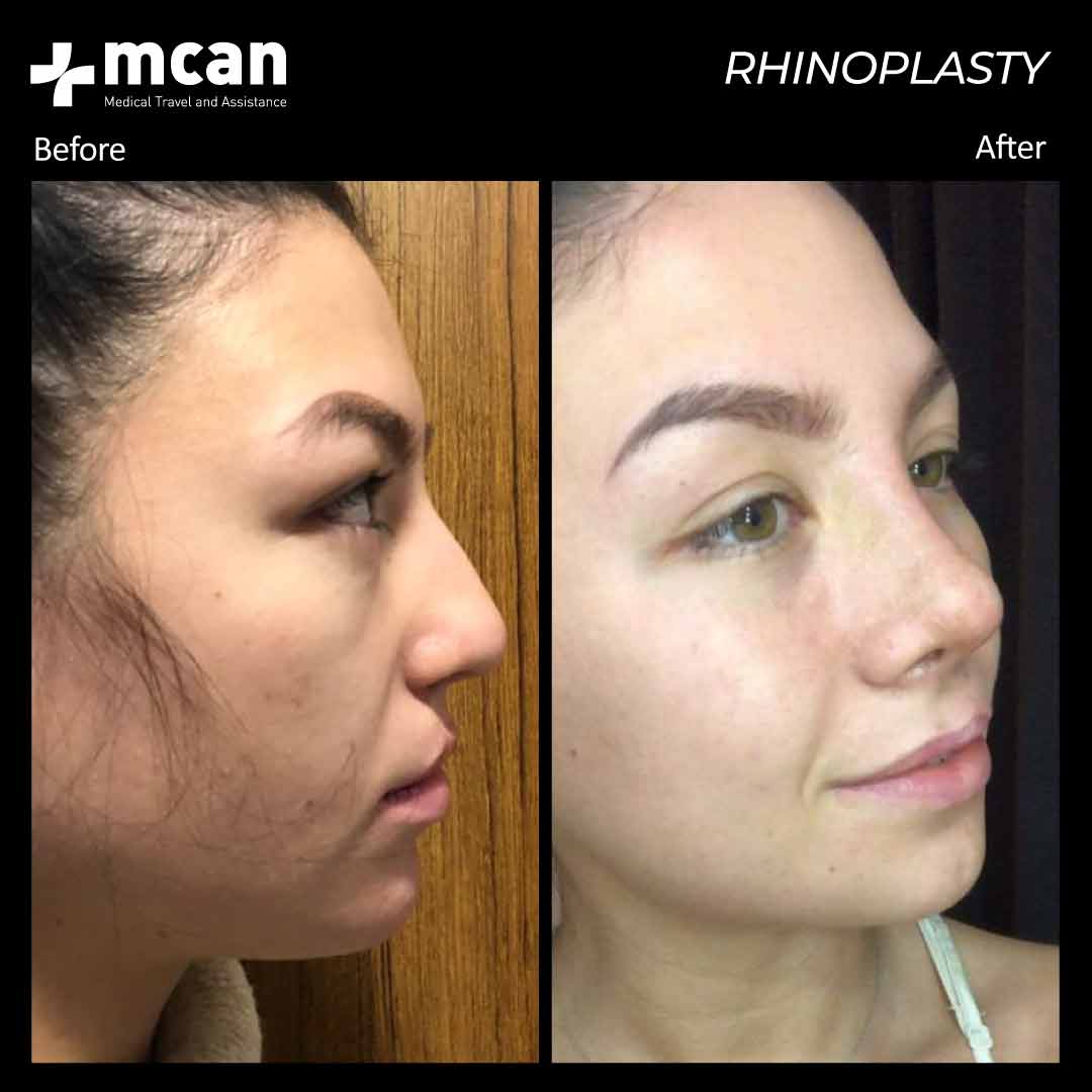 3.12.20 rhinoplasty before after