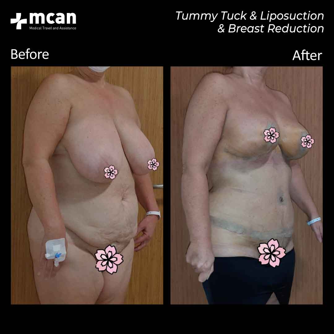 30.07.20 tummy tuck liposuction breast reduction
