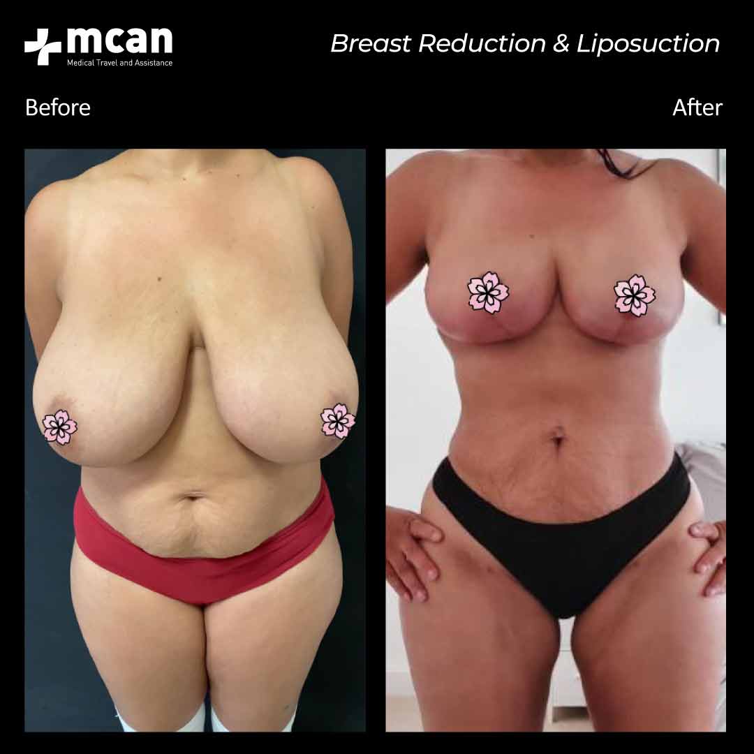 30.09.20 breast reduction liposuction 1