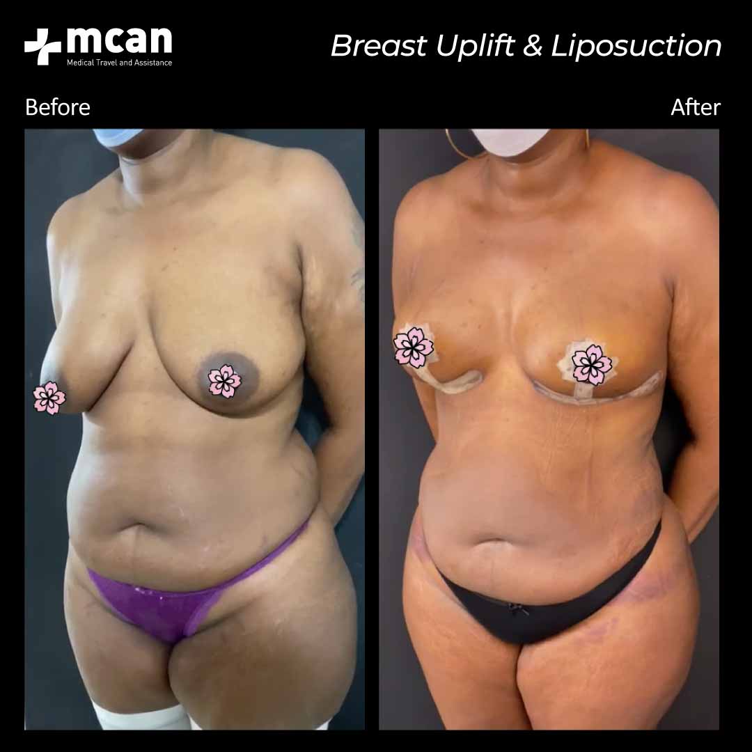 30.09.20 breast uplift liposuction