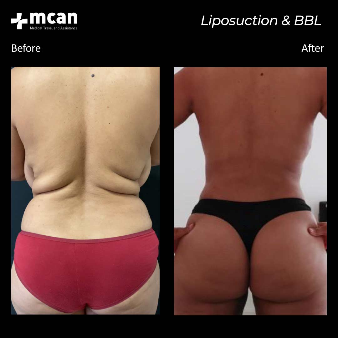 30.09.20 liposuction bbl