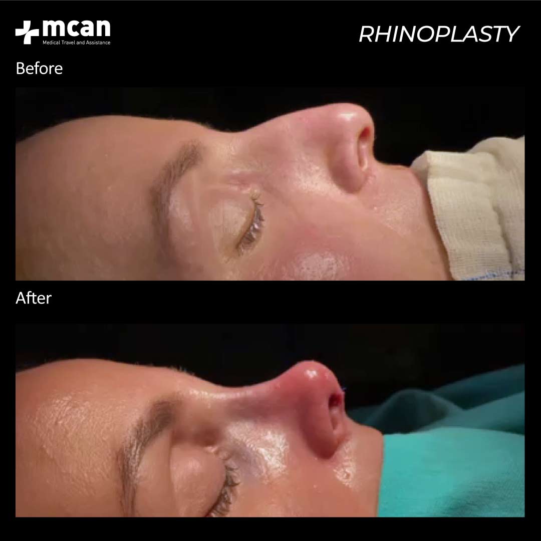8.12.20 rhinoplasty before after 2