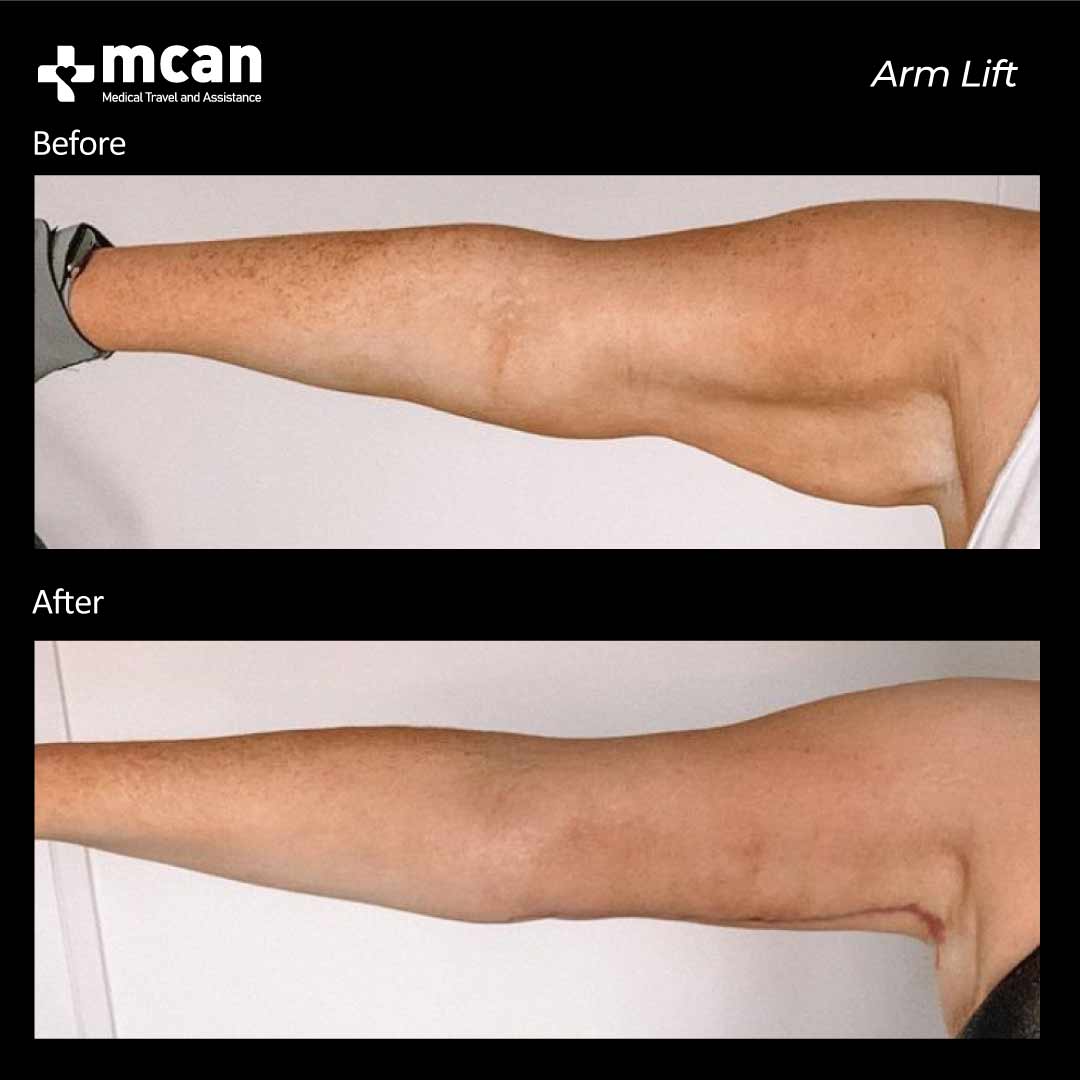 Arm Lift Turkey Before After 17022101