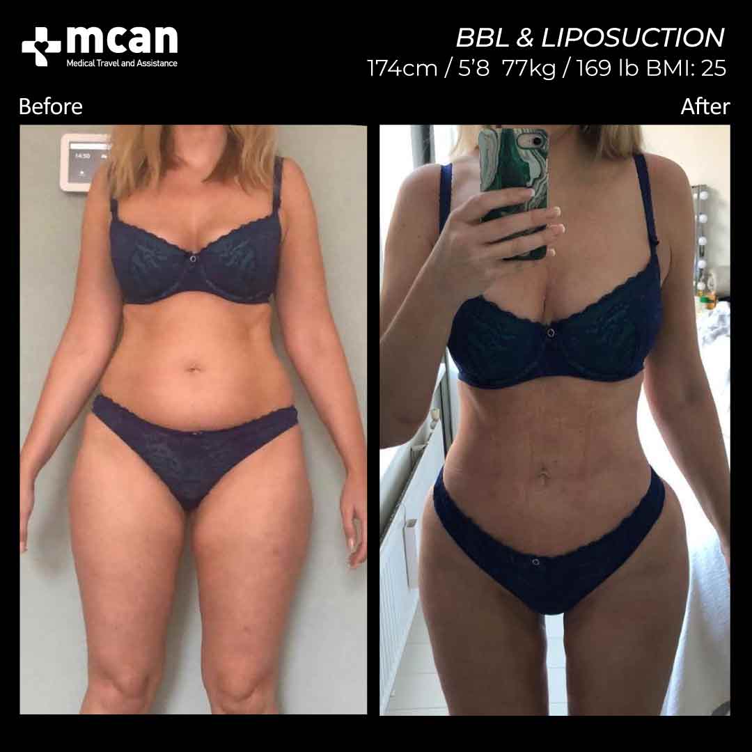 BBL Liposuction Turkey Before After 17022101