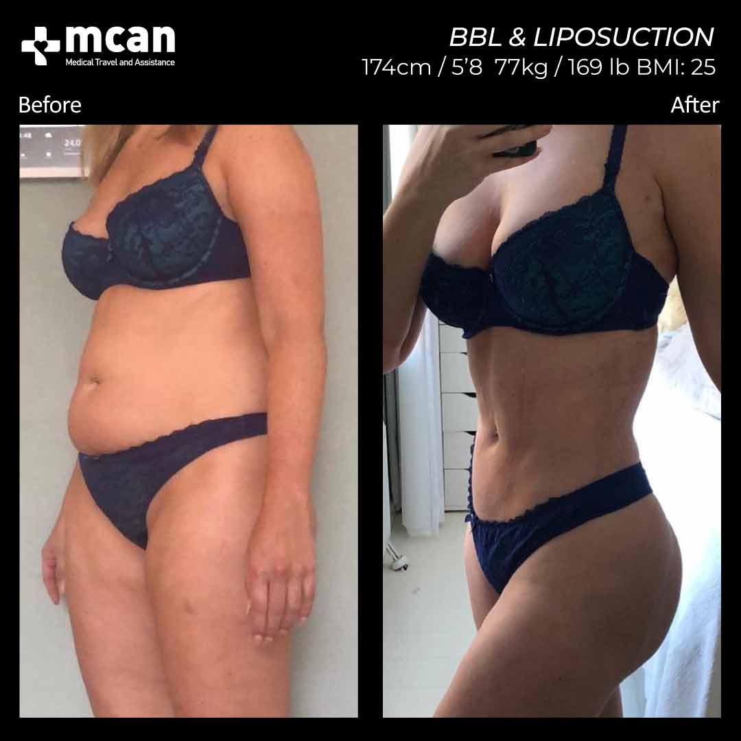 BBL Liposuction Turkey Before After 17022102
