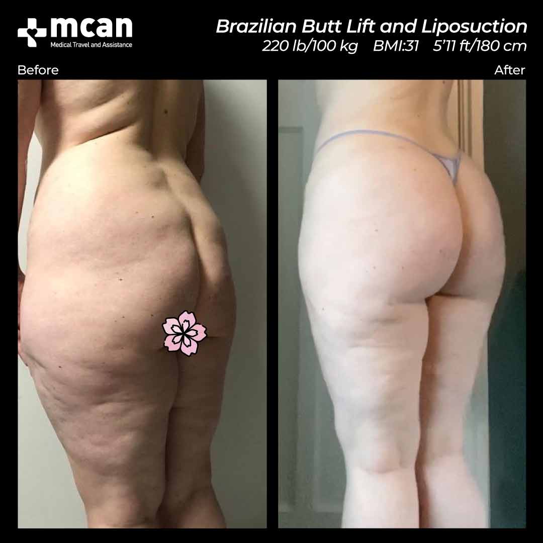 BBL Liposuction Turkey Before After 17022103