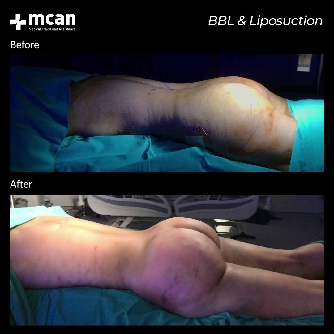 BBLLiposuction in Trkey Before After 2302 2