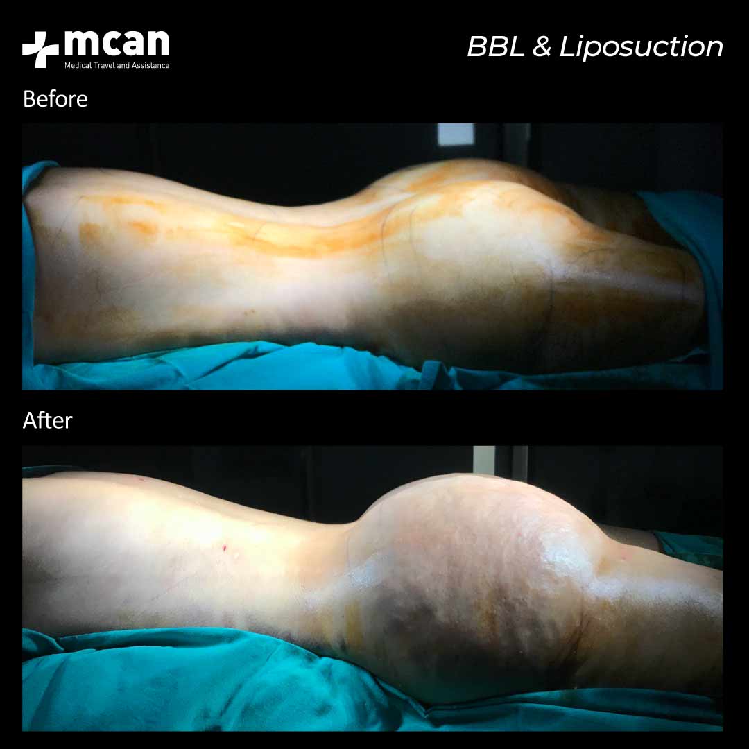 BBLLiposuction in Turkey Before After 2302