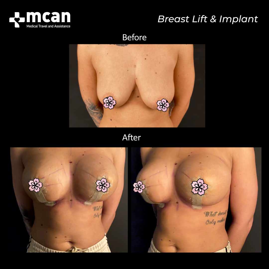 Breast Lift Implant Turkey Before After 17022101