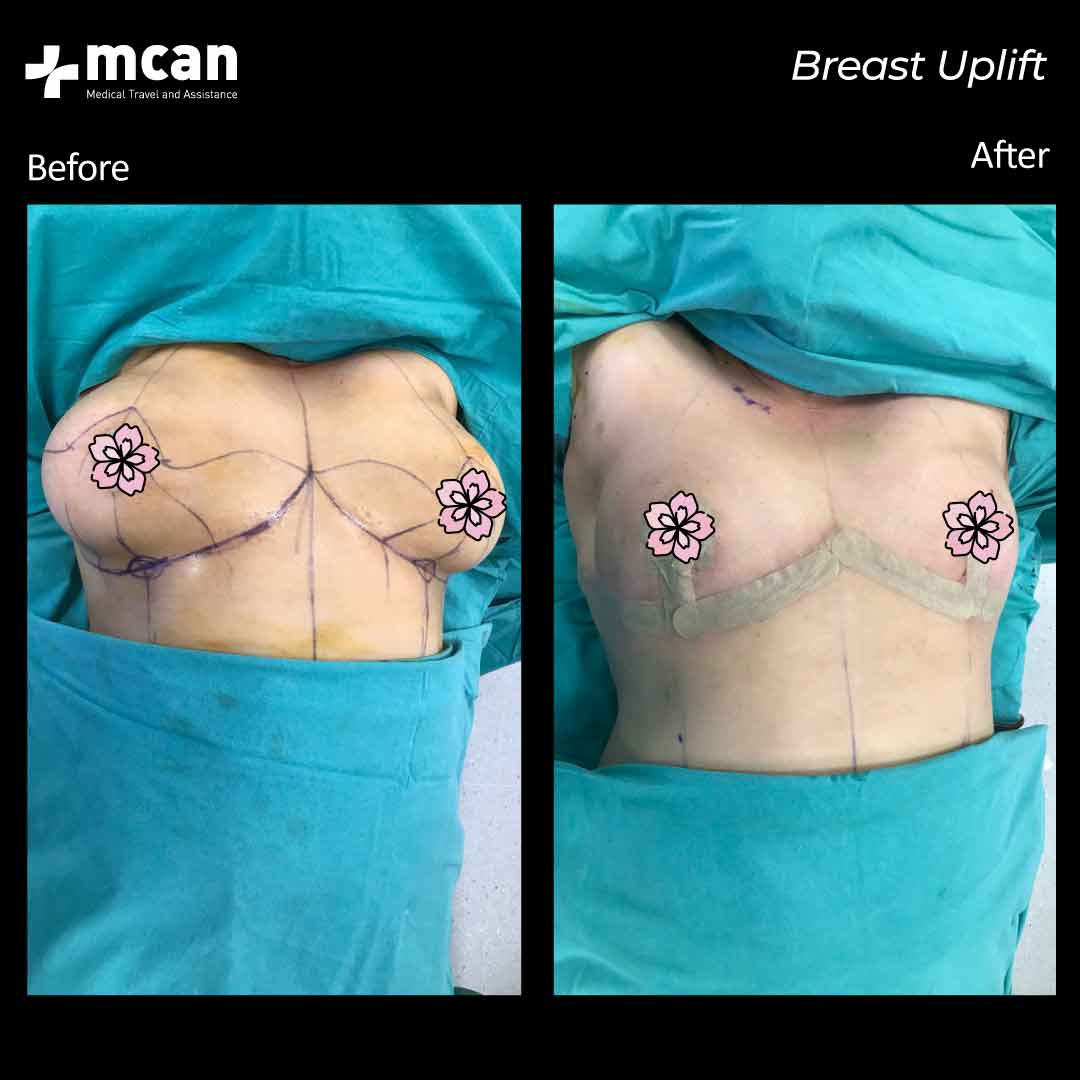 Breast Uplift Turkey Before After 2302
