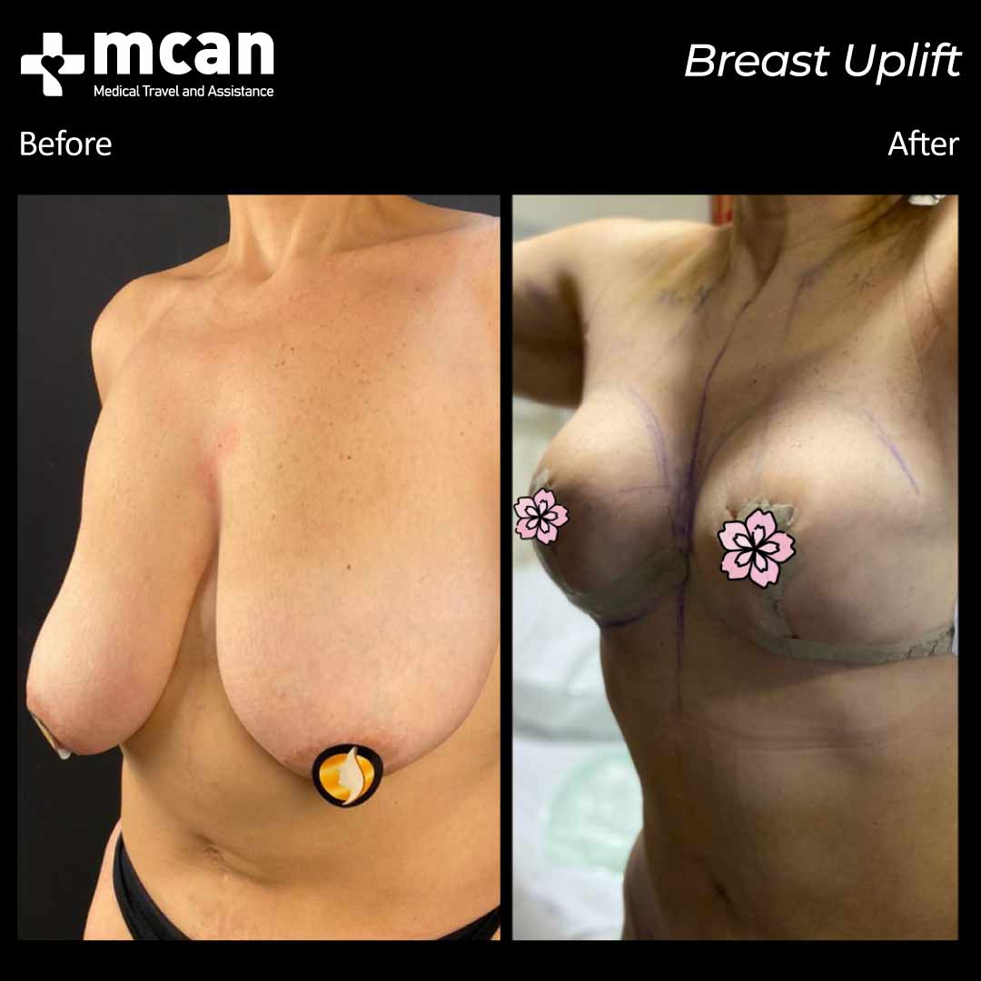 Breast Uplift Turkey Before After MCAN Health 02042101