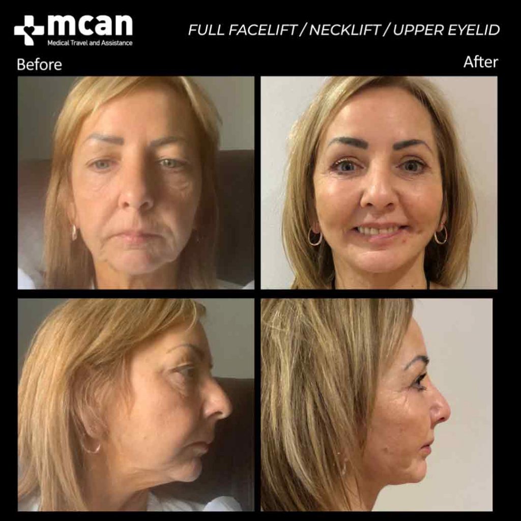 Full Facelift Necklift Upper Eyelid Turkey Before After 17022101