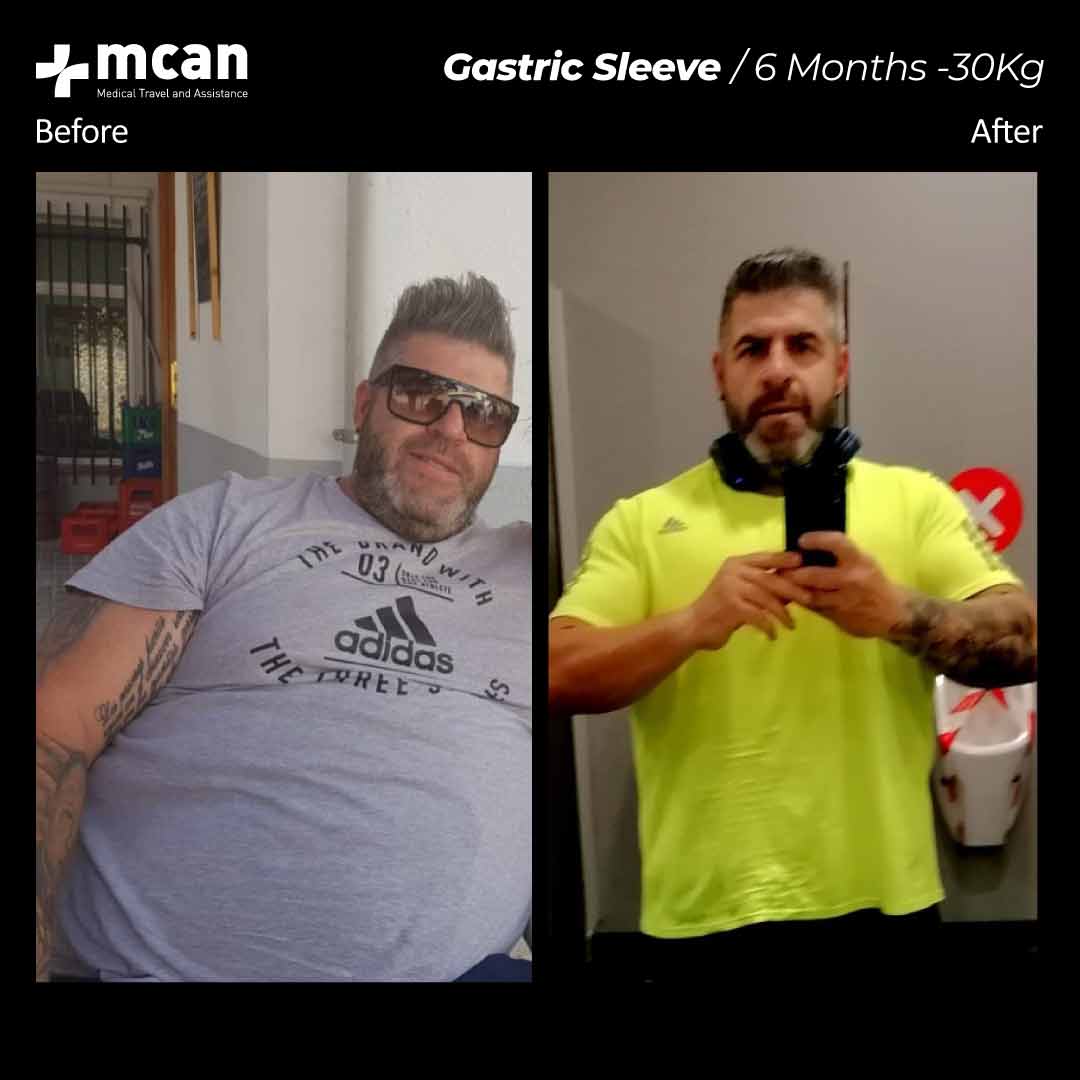 Gastric Sleeve Before After 301202