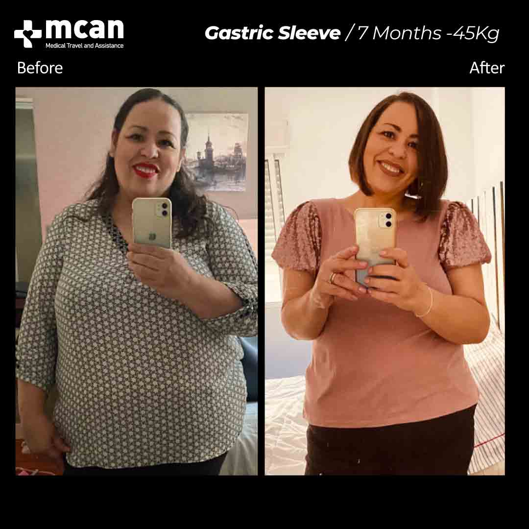 Gastric Sleeve Turkey Before After 17022101