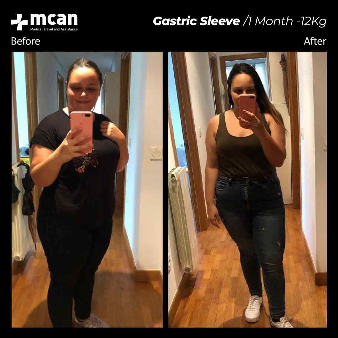 Gastric Sleeve Turkey Before After MCAN Health 02042101